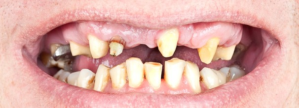 perder dientes afecta a la digestion 2