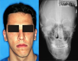importancia de deteccion de asimetrias faciales 3