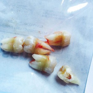 remueven 5 dientes de miley cyrus