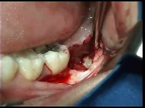 ansiedad infuye en recuperacion tras extraccion de tercer molar 3