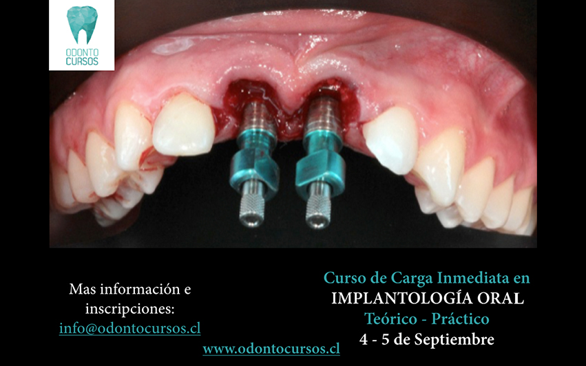 carga-inmediata_implantologia-oral