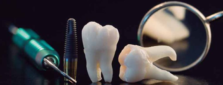 implante dental 3d 2