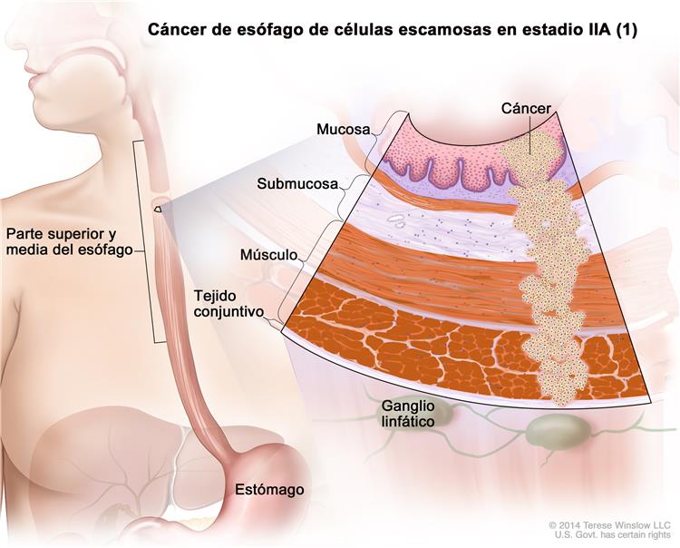 cancer de esofago
