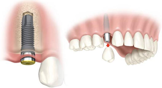 osteointegracion implantes dentales 2