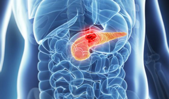 salud oral - cancer de pancreas