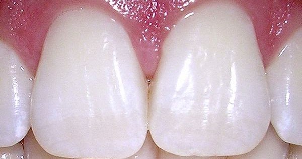esmalte-dental-enzima