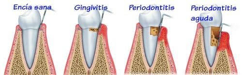 periodontitis y vitamina D