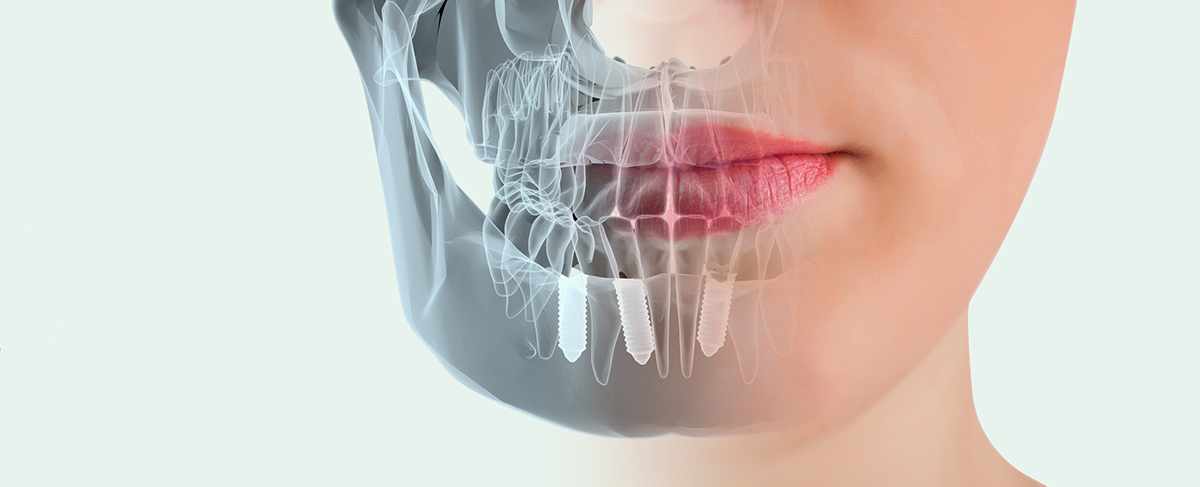implantes-dentales-osteoporosis