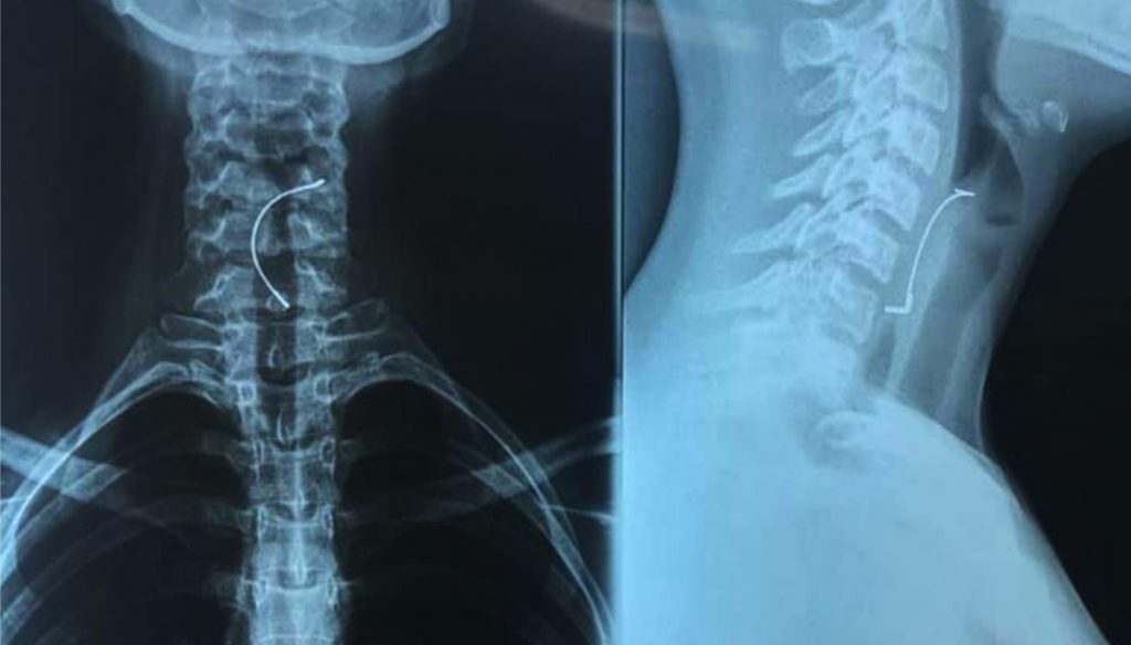 Radiografía de niña que aspiró su bracket odontológico en Paraguay.
