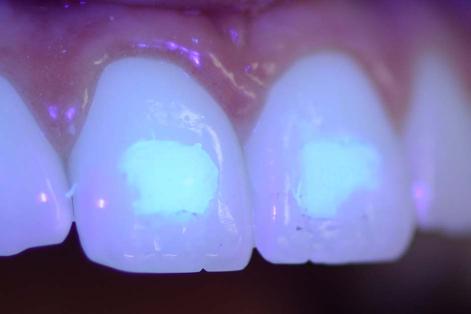 Investigan cómo remover el cemento dental en tratamientos no